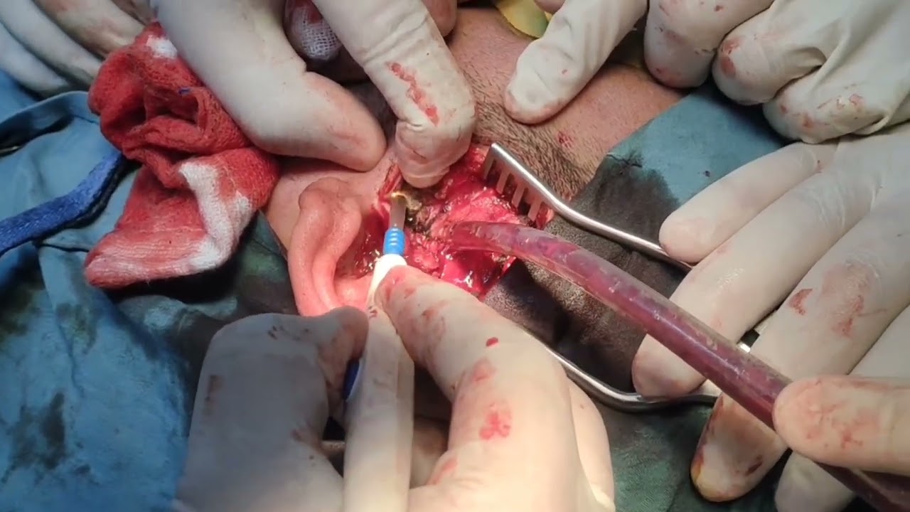 Surgery of recurrent TMJ dislocation by Dr. Mohamed Elshamaa