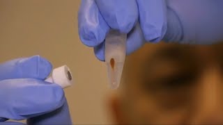 Potential blood test for Alzheimer's shows early promise