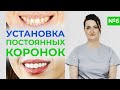 Протезирование зубов. Установка постоянных коронок / Заключительный этап протезирования