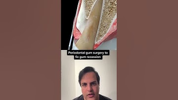 Gum surgery animation for gum recession#Surgery #gum#Dentistry #GumGrafting