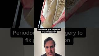 Gum surgery animation for gum recession#Surgery #gum#Dentistry #GumGrafting