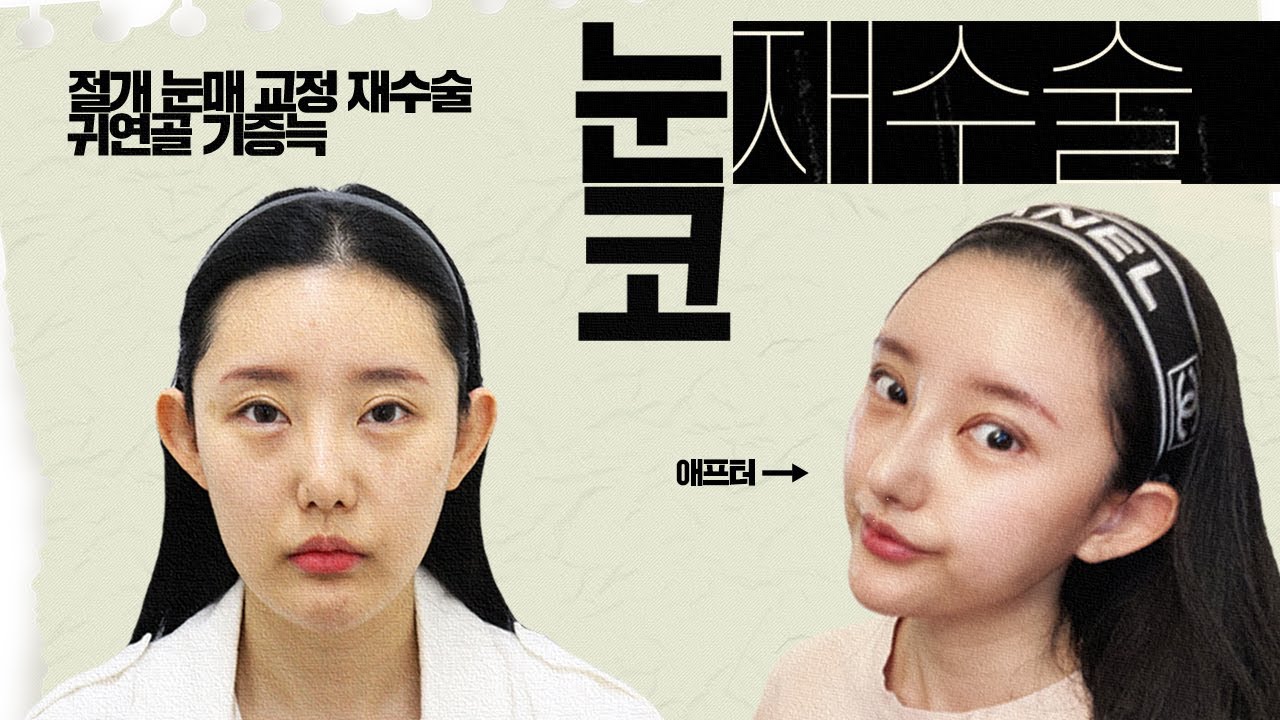 [VLOG] 🐯 사나워 보이는 인상을 싹 바꾸고 싶어요~  눈 재수술👁️ + 코 재수술👃