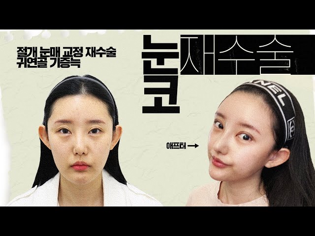 [VLOG] 🐯 사나워 보이는 인상을 싹 바꾸고 싶어요~  눈 재수술👁️ + 코 재수술👃
