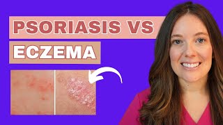 Do you Have Psoriasis or Eczema?