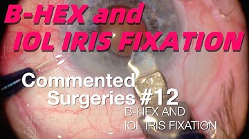 COMMENTED SURGERIES #12 - B-HEX and IOL Iris Fixation