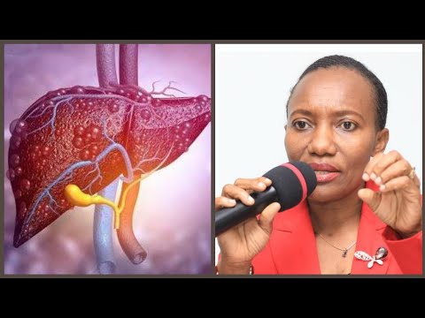 3 5 WATANZANIA WANAISHI NA VIRUSI VYA HOMA YA INI AINA B WENGINE 1 WANA AINA C NAIBU KATIBU MKUU