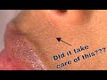 FLAWLESS Finishing Touch facial hair remover. How did it do?