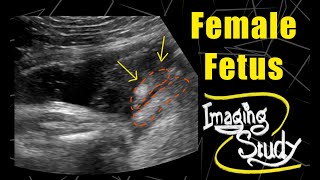 Female Fetus - Its a Girl || Ultrasound || Case 77