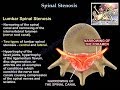 Lumbar Spinal Stenosis - Everything You Need To Know - Dr. Nabil Ebraheim