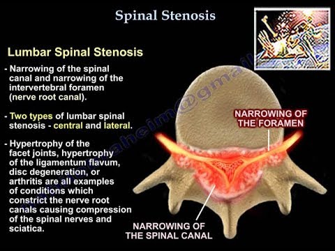 Lumbar Spinal Stenosis - Everything You Need To Know - Dr. Nabil Ebraheim