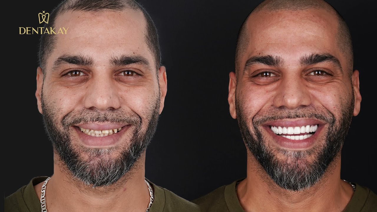 Révélons Votre Sourire Caché avec Hollywood Smile! | Dentakay | Hollywood Smile en Turquie