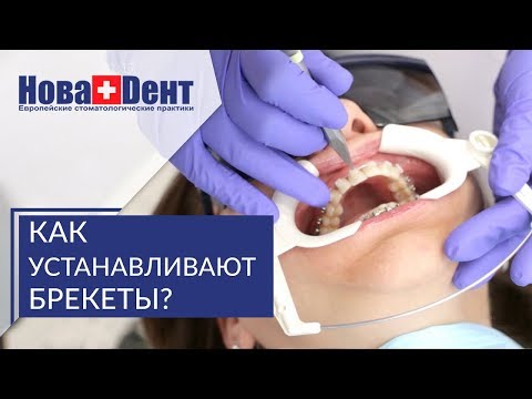 Этапы установки брекетов. ☝ Подготовка и этапы установки брекетов. НоваДент. 12+ Этапы установки брекетов. ☝ Подготовка и этапы установки брекетов. НоваДент. 12+