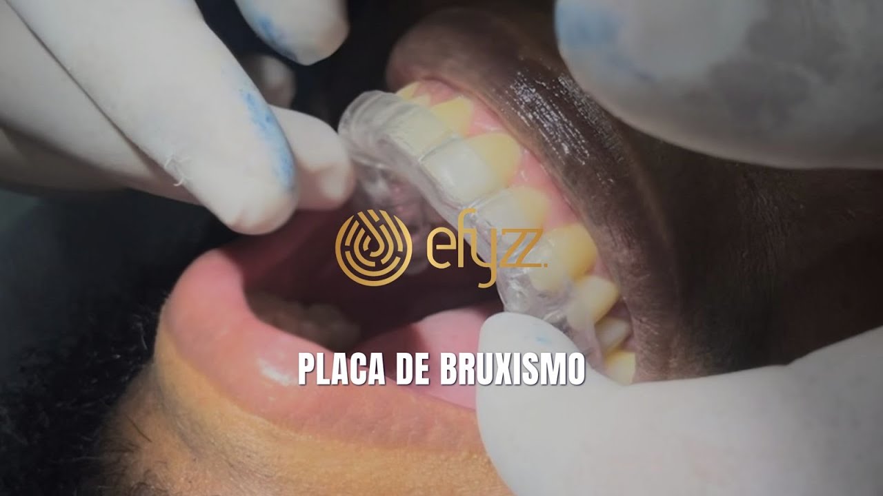 Produção e instalação de placa de bruxismo