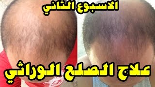 علاج تساقط الشعر و الصلع الوراثي بالزيت و الثوم | الأسبوع الثاني