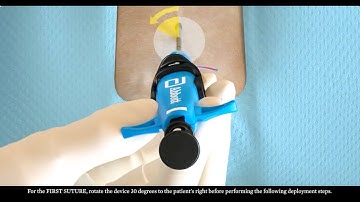 U.S. Perclose ProStyle Multiple Device Deployment Video