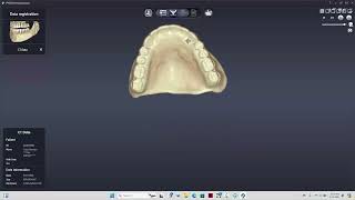 Copy Dentures in your CBCT!