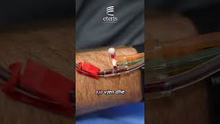 Seanca e tretë e Therapeutic Plasma Exchange (TPE) në Eteris Clinic Day Hospital.