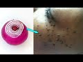 REMOVE SKIN TAG OVERNIGHT POWERFUL REMEDY