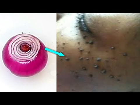 REMOVE SKIN TAG OVERNIGHT POWERFUL REMEDY
