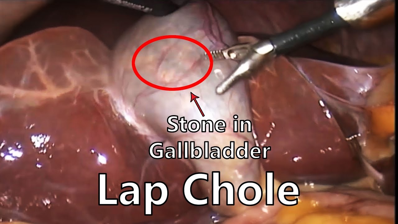 Gallbladder Stone Surgery laparoscopic cholecystectomy