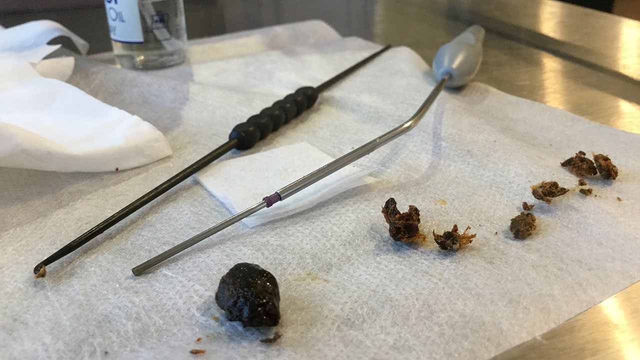 515 St Barts Ear Hook and Microsuction Dry Ear Wax Removal YouTube