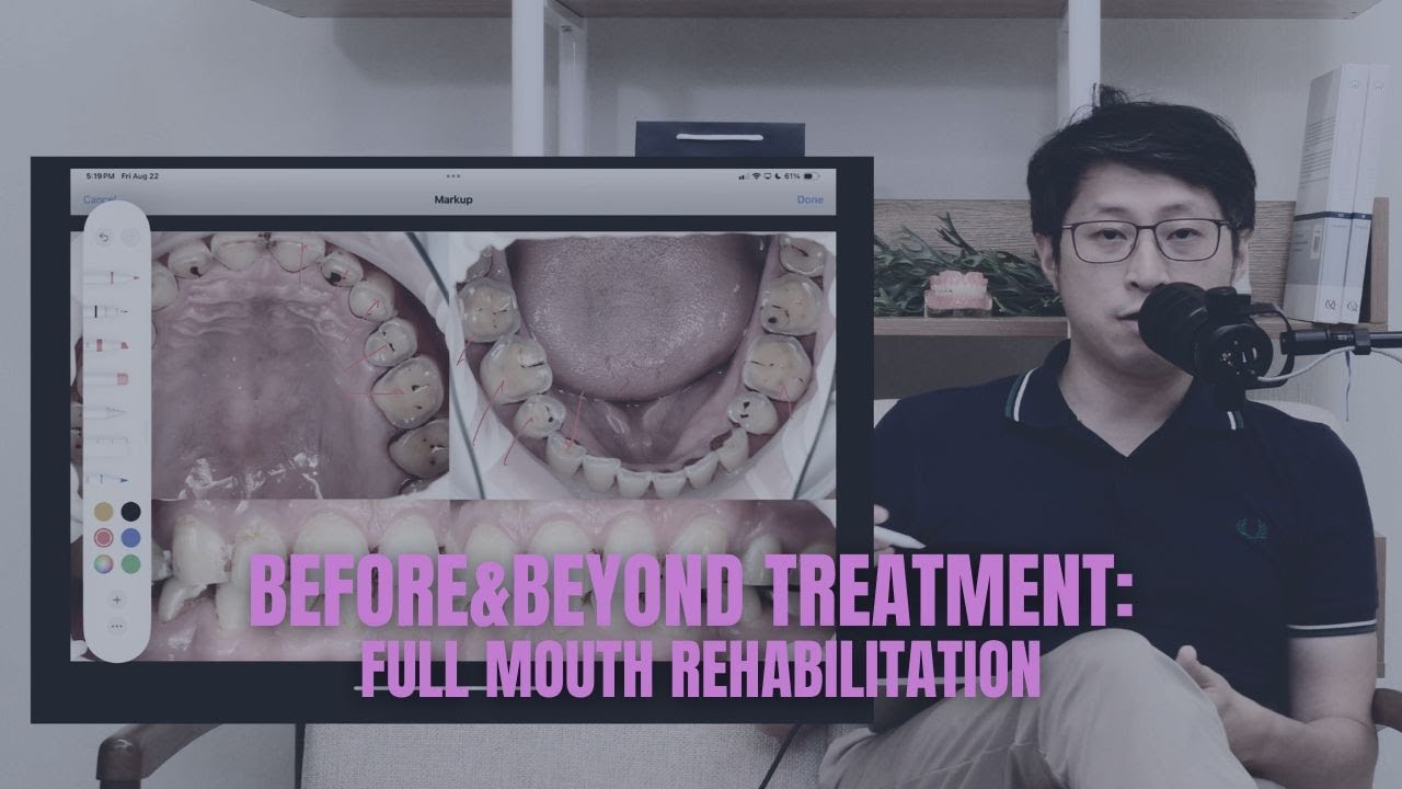 Full Mouth Rehabilitation: Understanding The Process | BEFORE & BEYOND EP36