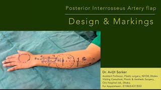 Posterior interosseus artery (PIA) flap : How to design!!!!