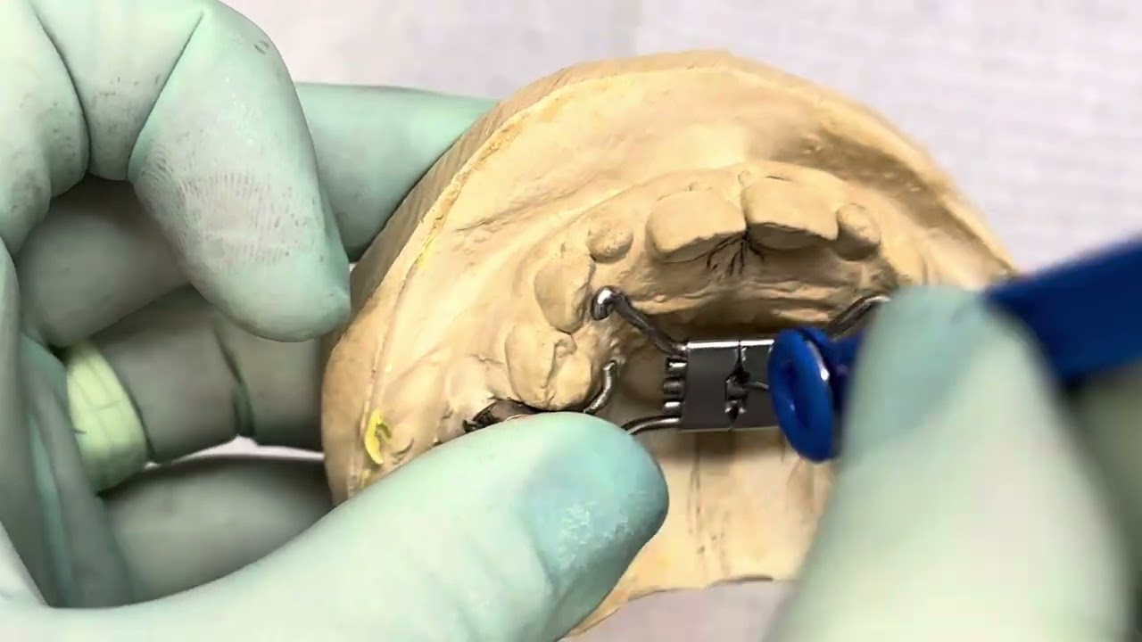 Como ativar o disjuntor maxilar (expansor fixo da maxila)? Passo a passo