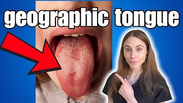 Discover The Root Causes Of Geographic Tongue!