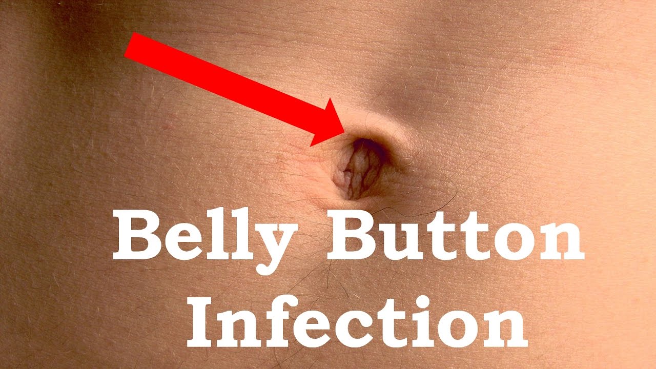 How to Treat Belly button Infection