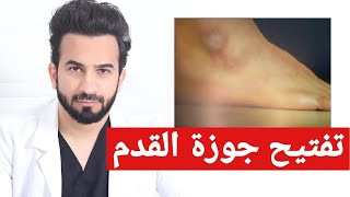 تفتيح جوزة القدم والتخلص من اسمرارها - دكتور طلال المحيسن