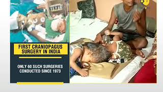 India rare surgery: Conjoined twins at head separated