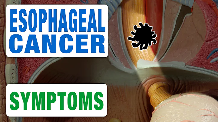 Esophageal Cancer - All Symptoms - DayDayNews