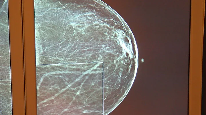 Ohio House Bill 371 could help women afford advanced breast cancer screenings