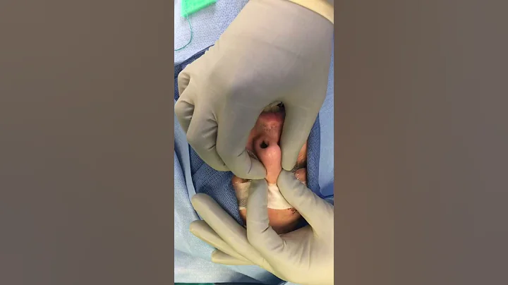 Dr. Jeremy White fixes a Broken Nose