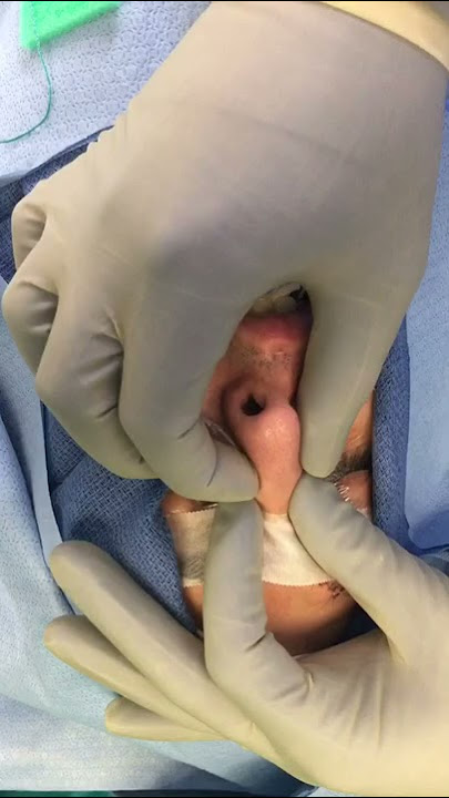 Dr. Jeremy White fixes a Broken Nose