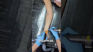 Laser tattoo removal of sleeve tattoo 😮👀  -  🎥 helltatto