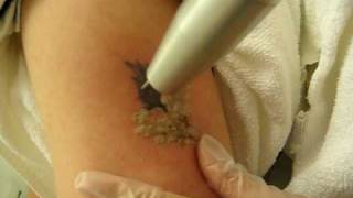Laser Tattoo Removal