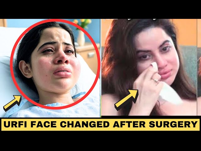 Urfi Javed Face Completely Changed After Lip Filler Removal Surgery -  YouTube