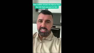 Sam Walker Shows Off His Injuries From The Attack