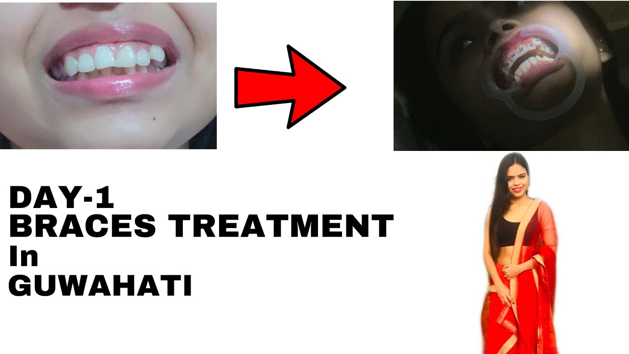 DAY 1 BRACES TREATMENT IN GUWAHATI COST AND TIME? MANY MORE YouTube