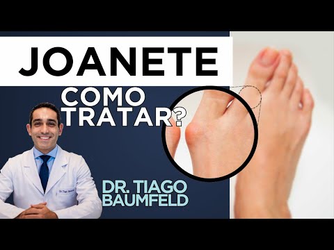 Cirurgia para Joanete: Hallux Valgus o que é e como funciona? Cirurgia para Joanete: Hallux Valgus o que é e como funciona?