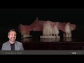 Digital partial dentures