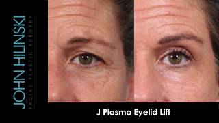 Non-Surgical Eyelid Lift Without Eyelid