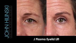 Non-Surgical Eyelid Lift