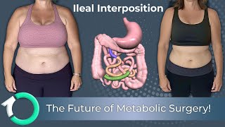 Ileal Interposition A Revolutionary Diabetes Weight Loss Surgery
