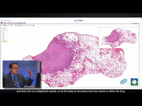 Lung Granulomas Caused by Fungal Infection