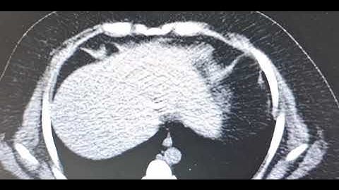 RING ARTIFACT IN COMPUTED TOMOGRAPHY IMAGE