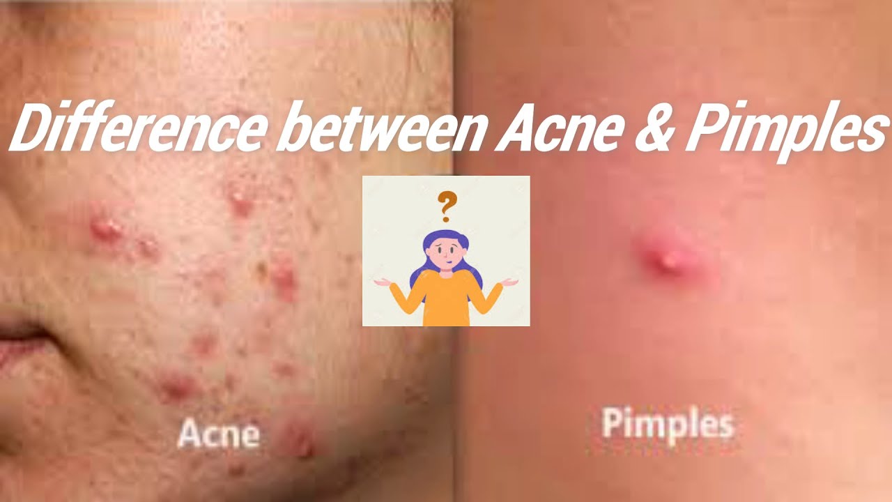 Difference between Acne & Pimples || Beauty tips - YouTube