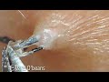 毛掘りneo［Ingrown hair］13